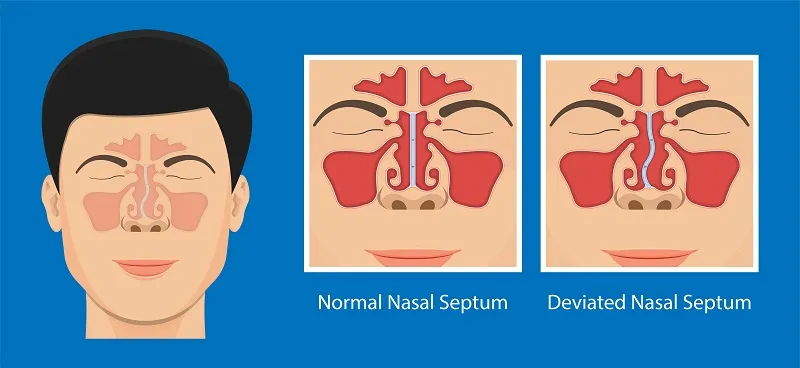Septoplasty: Breathing Before, Swelling After, Results